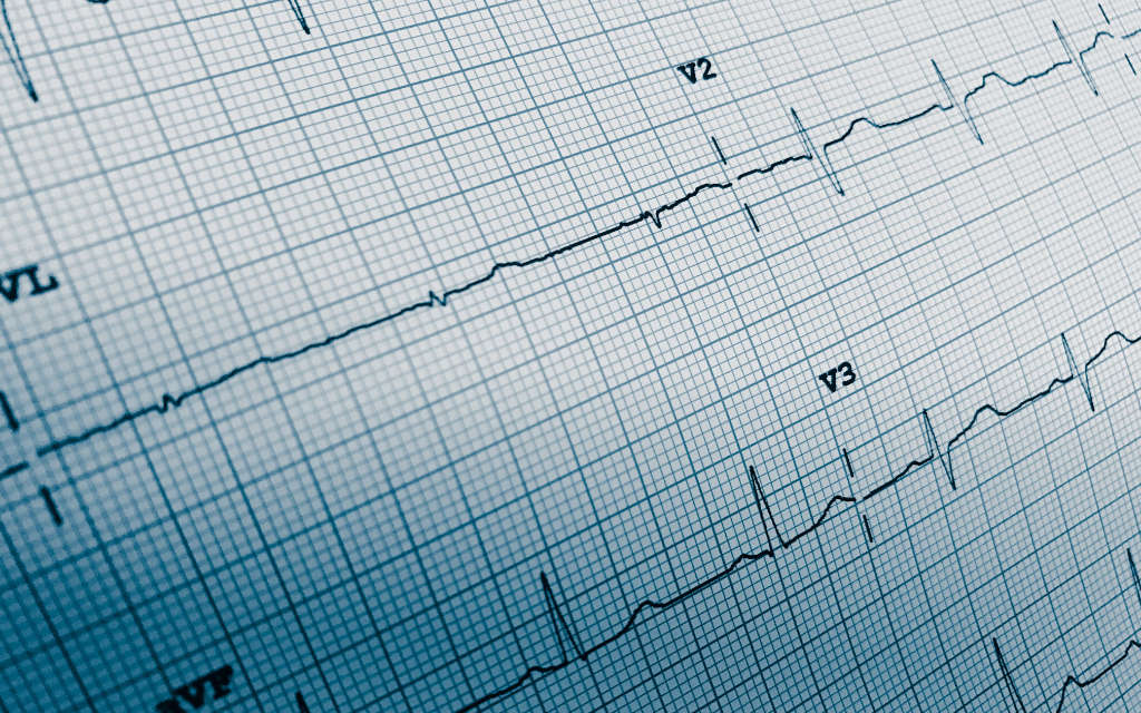 Ruhe-EKG